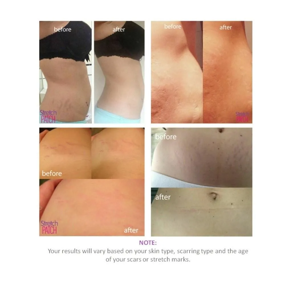 StretchPatch ORIGINAL Formula, Lotion Infused Hot Patch for Scars and Stretch Marks, 7 ea (20 x 15cm)
